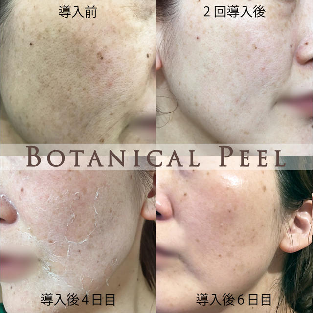 BOTANICAL 濡れ ボタニカルピーリング BOTANICAL 濡れ ボタニカルピーリング
