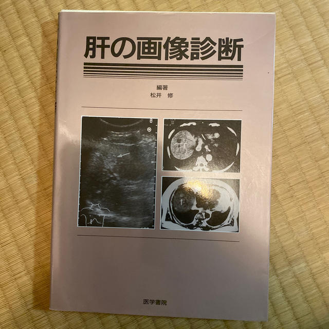 健康/医学肝の画像診断