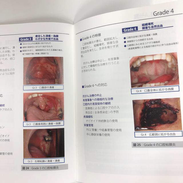 がん治療における口腔粘膜支持療法の為の口腔粘膜炎評価マニュアル エンタメ/ホビーの本(健康/医学)の商品写真