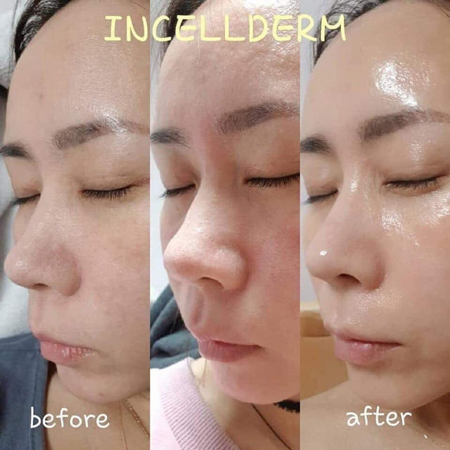 INCELLDERM インセルダム クリーム2個セット　新品未開封・お得 2