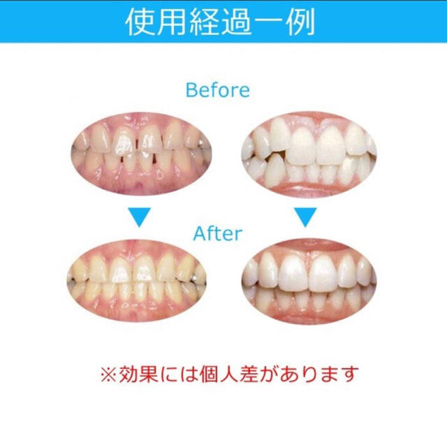 大人気◆最安値◆ マウスピース  矯正 歯ぎしり対策◆ コスメ/美容のオーラルケア(口臭防止/エチケット用品)の商品写真