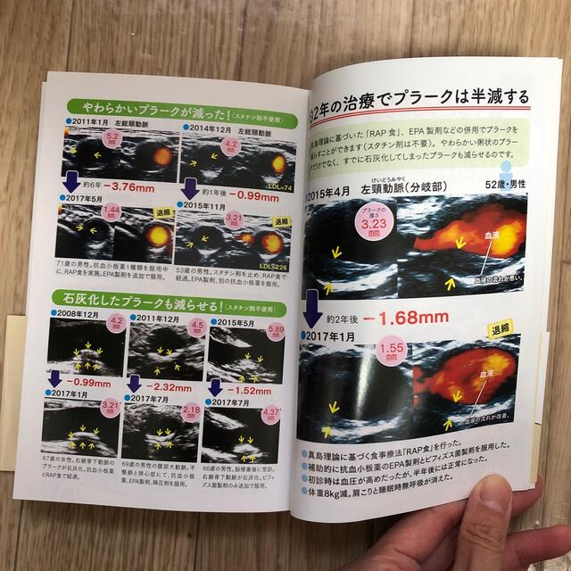 脳梗塞・心筋梗塞・高血圧は油が原因 動脈硬化は自分で治せる エンタメ/ホビーの本(健康/医学)の商品写真