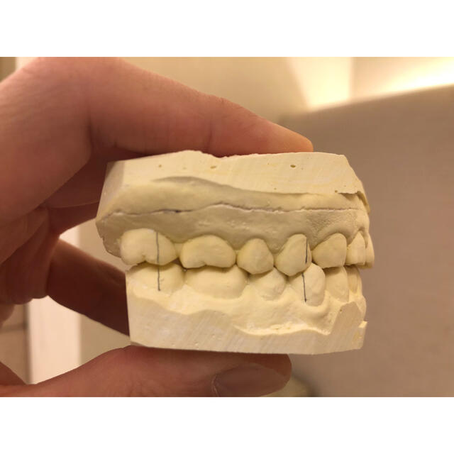 歯型