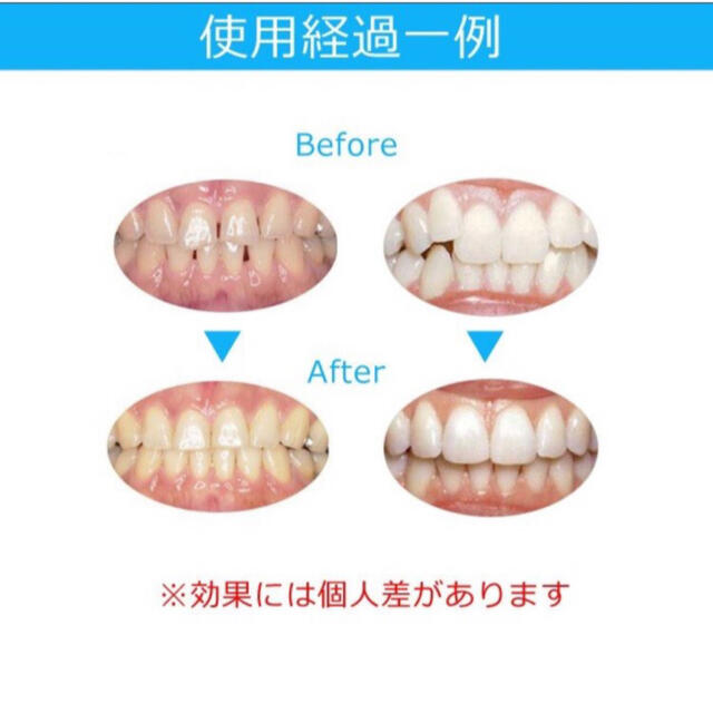 大人気◆最安値◆ マウスピース  矯正 歯ぎしり対策◆ コスメ/美容のオーラルケア(口臭防止/エチケット用品)の商品写真