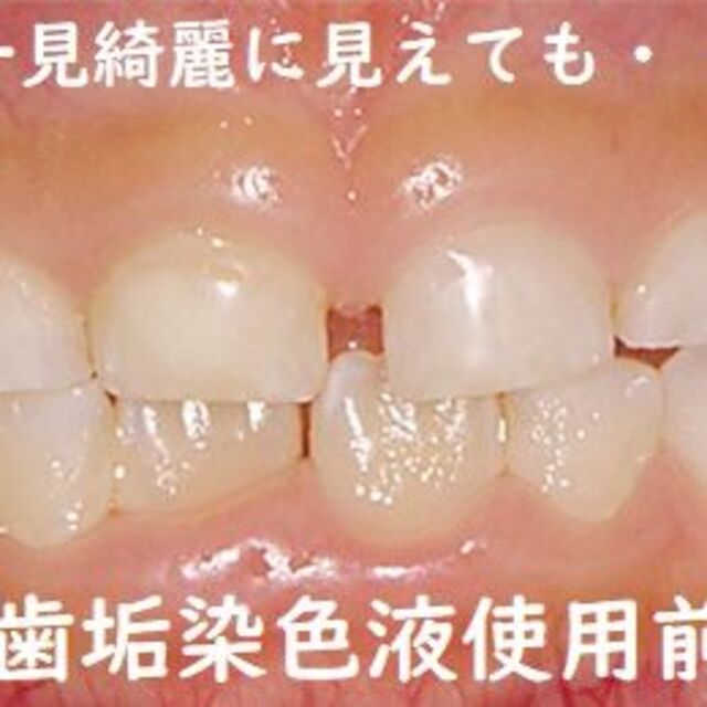 歯磨きが苦手な人のためのお試し歯周病予防歯磨きセット コスメ/美容のオーラルケア(歯ブラシ/デンタルフロス)の商品写真