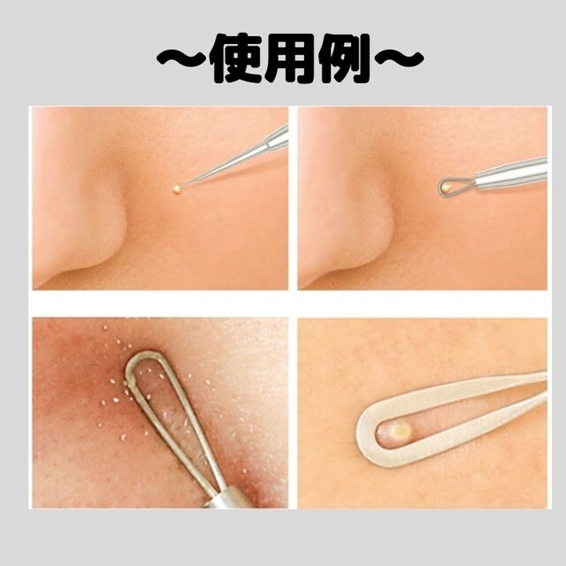 角栓 ピンセット 角栓取り 毛抜き 精密 毛穴 ピンセット ステンレススチール ニキビ 毛穴ケア 角質除去 コメドプッシャー 黒ずみ 角栓除去 ピンセット ニキビケアセット 5本 角栓 黒ずみ フェイスケア プッシャー 角質除去