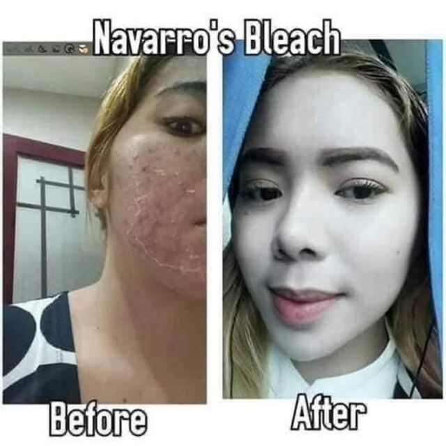 CLEARANCE SALE NAVARRO’s BLEACHING SET