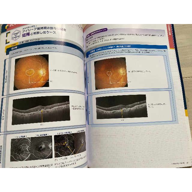 加齢黄斑変性 診断と治療 ストラテジックアトラス エンタメ/ホビーの本(健康/医学)の商品写真