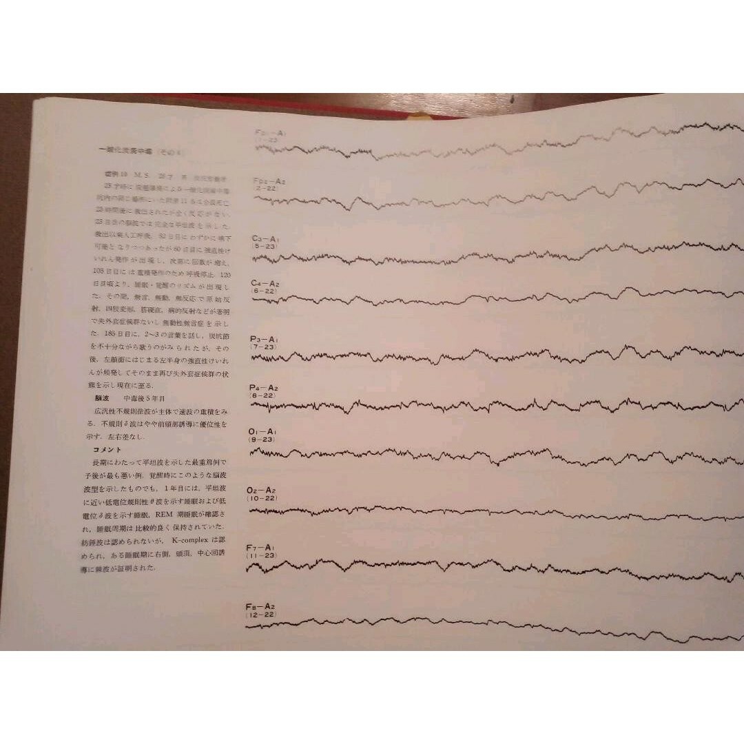 脳波アトラス 全5巻 文光堂 神経内科医　医学生向け