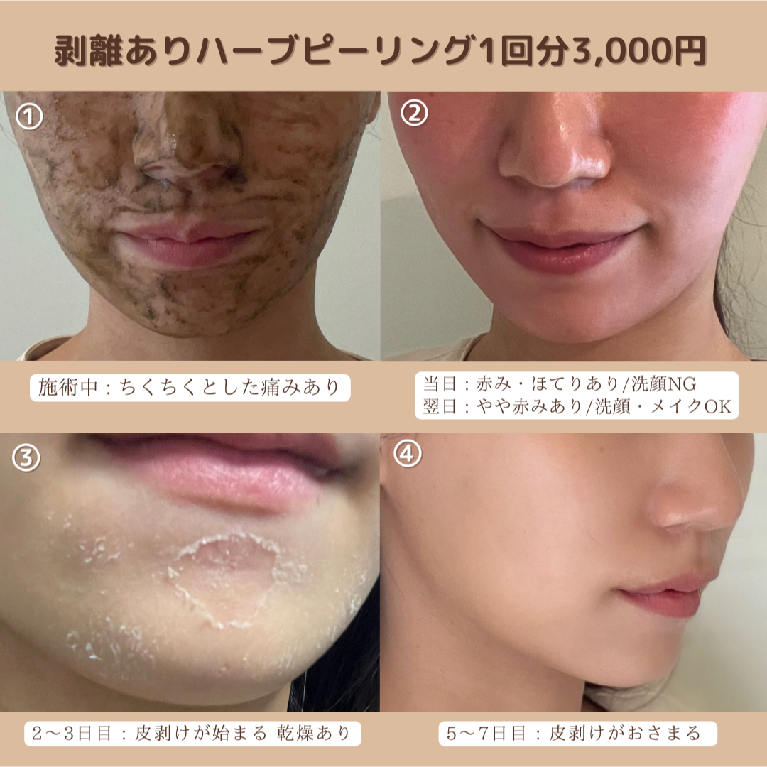 ハーブピーリング3〜10回分自然剥離あり - 基礎化粧品 ハーブピーリング3〜10回分自然剥離あり - 基礎化粧品