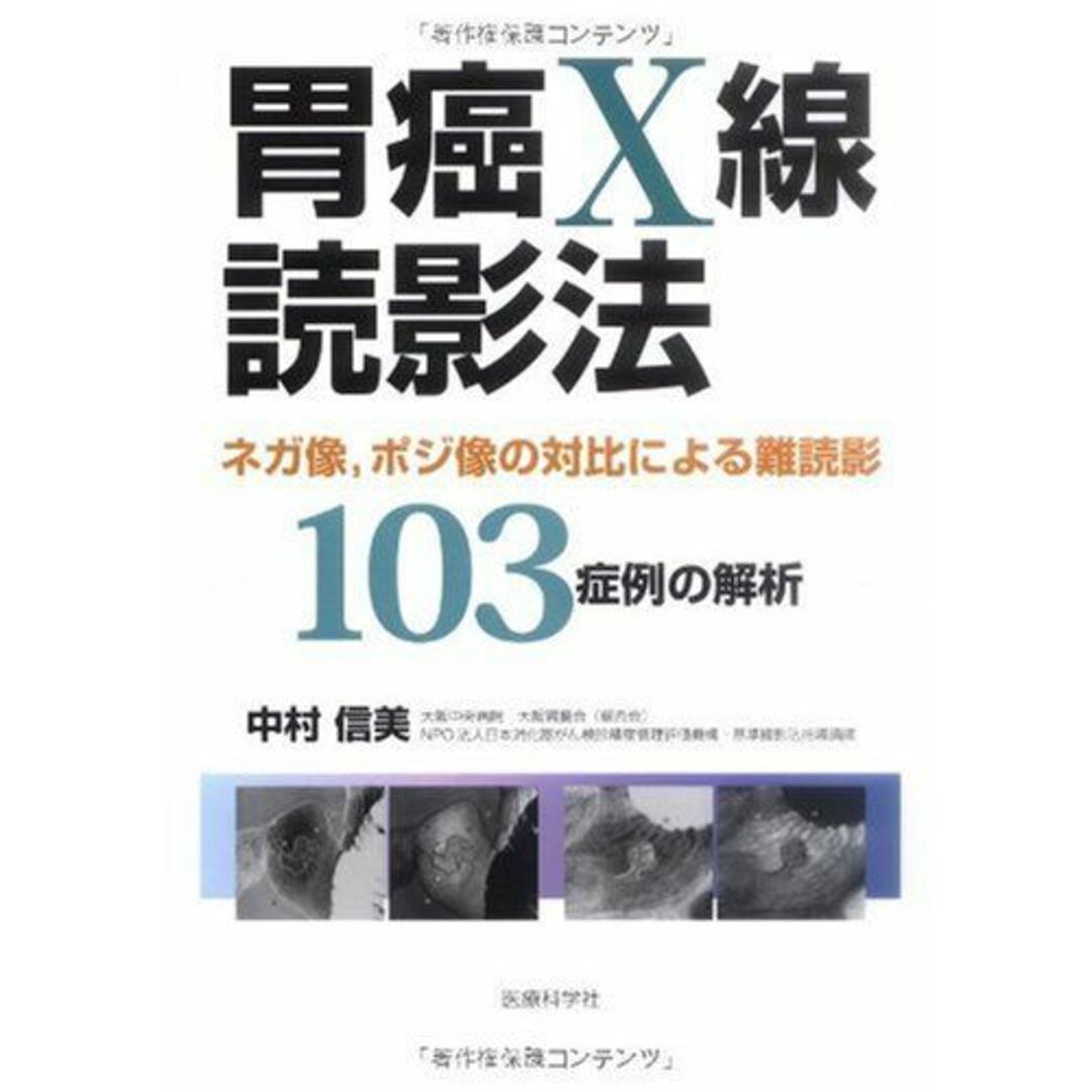 胃癌X線読影法─ネガ像，ポジ像の対比による難読影103症例の解析─ [単行本（ソフトカバー）] 中村 信美