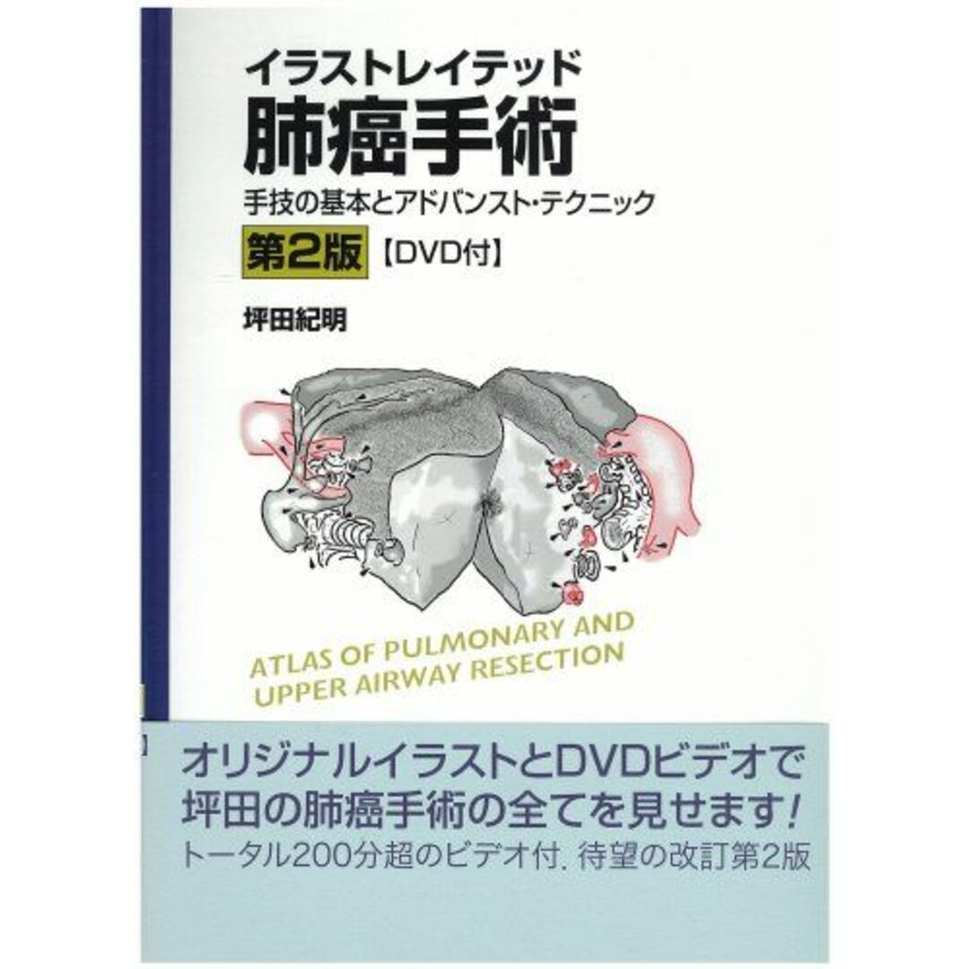 イラストレイテッド肺癌手術[DVD付]―手技の基本とアドバンスト・テクニック [大型本] 坪田　紀明