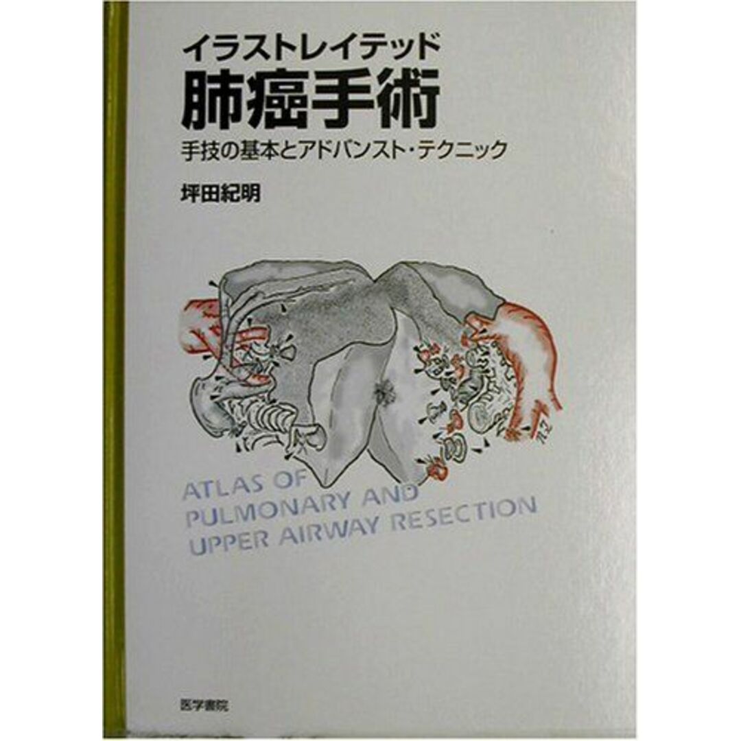 イラストレイテッド肺癌手術―手技の基本とアドバンスト・テクニック 坪田 紀明