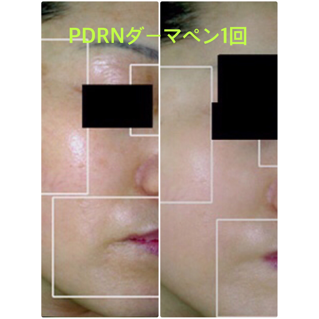 PDRN+ヒアルロン酸　5ml 1本　ダーマペンに最適