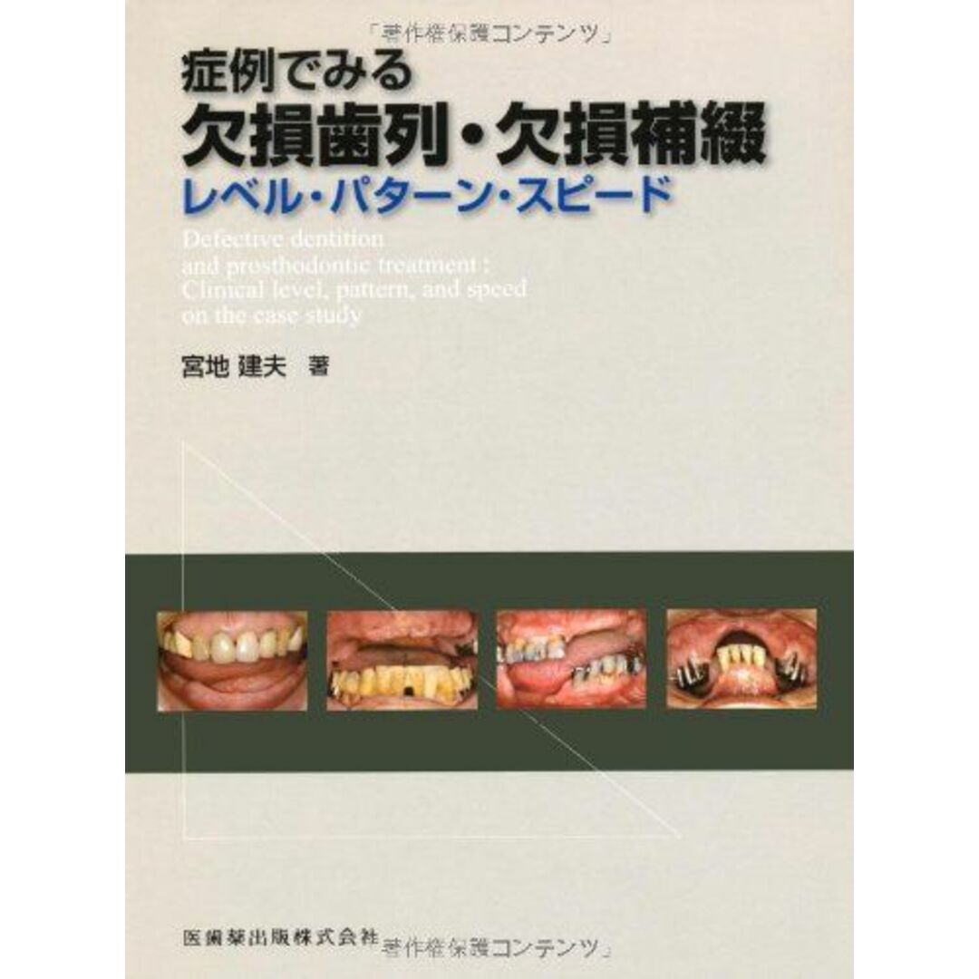 症例でみる欠損歯列・欠損補綴レベル・パターン・スピード