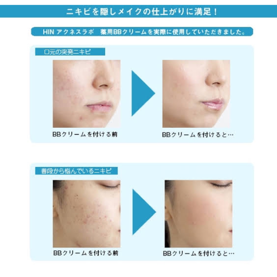 Acnes Labo(アクネスラボ)のhinアクネスラボ　薬用BB コスメ/美容のベースメイク/化粧品(BBクリーム)の商品写真