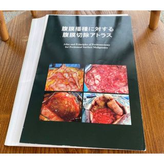 腹膜播種に対する腹膜切除アトラス(健康/医学)