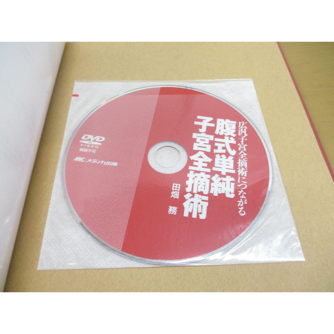 腹式単純子宮全摘術: 広汎子宮全摘術につながる (産婦人科手術スーパー 腹式単純子宮全摘術: 広汎子宮全摘術につながる (産婦人科手術スーパー