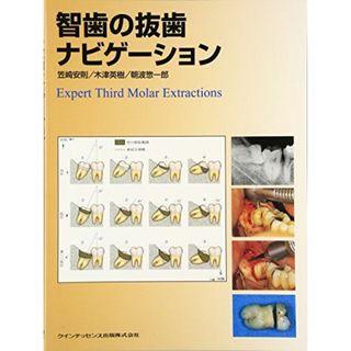智歯の抜歯ナビゲ-ション