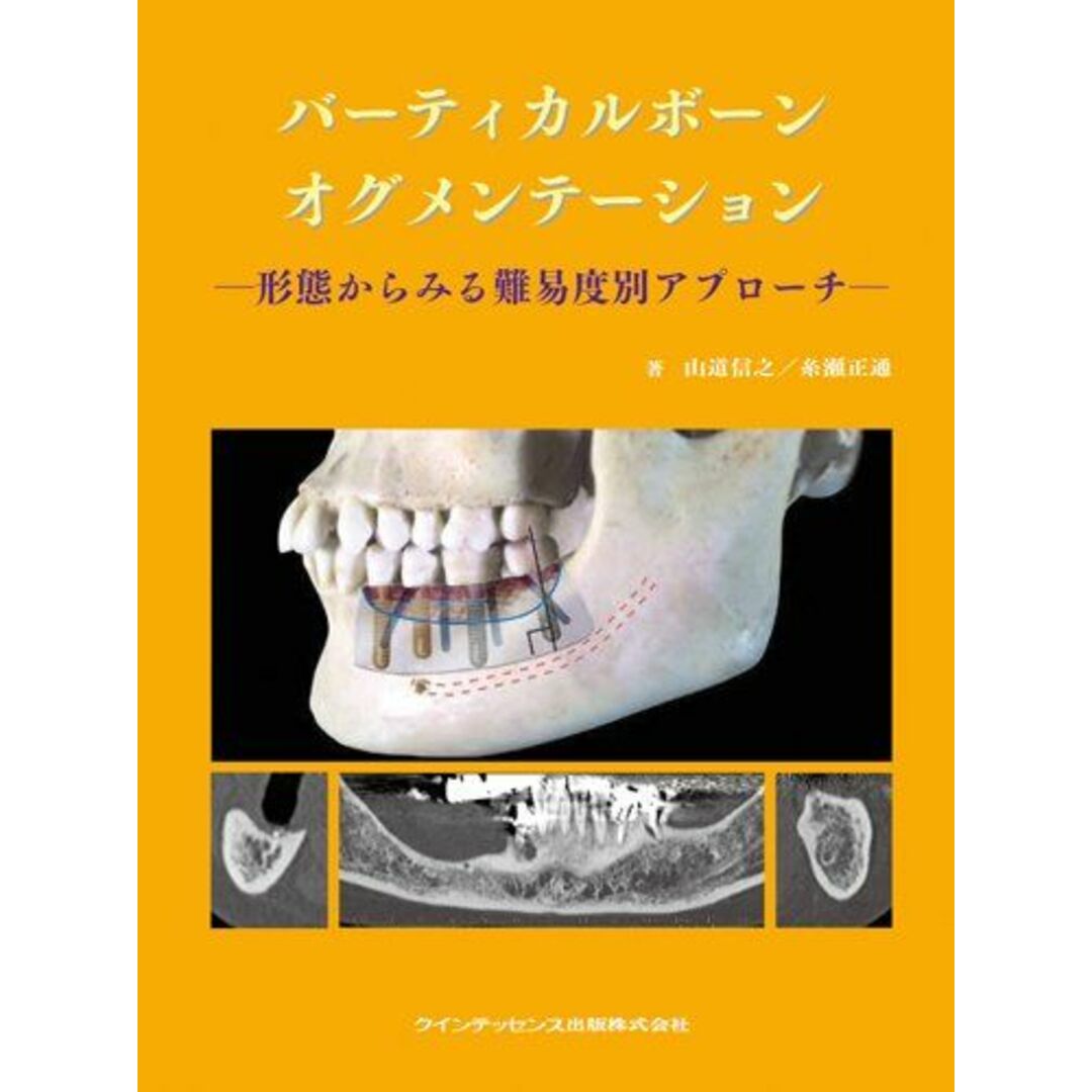 バーティカルボーンオグメンテーション