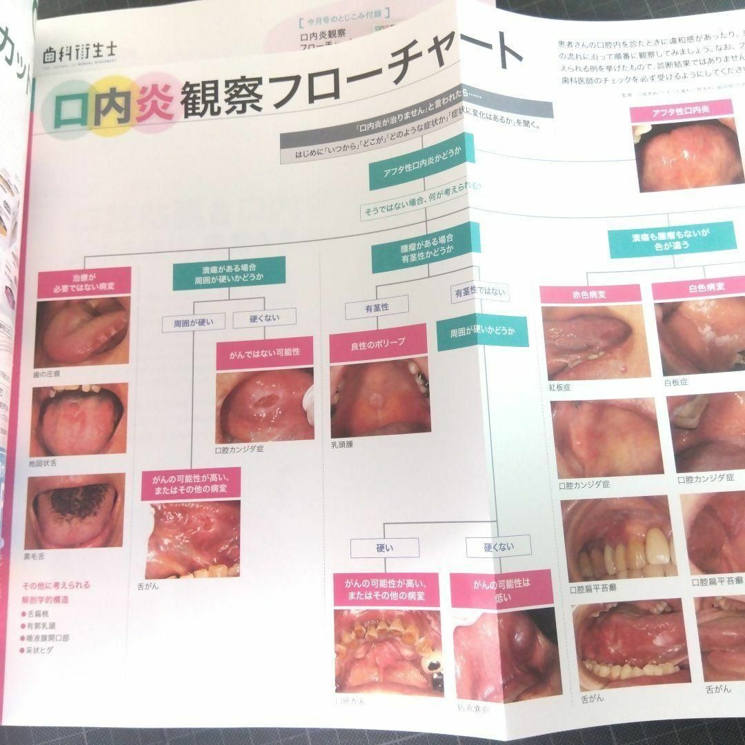 歯科衛生士　2024年3月号　口腔粘膜&口内炎の診かた エンタメ/ホビーの本(健康/医学)の商品写真