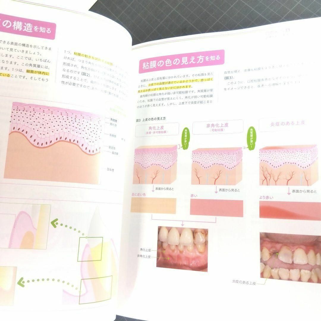 歯科衛生士　2024年3月号　口腔粘膜&口内炎の診かた エンタメ/ホビーの本(健康/医学)の商品写真