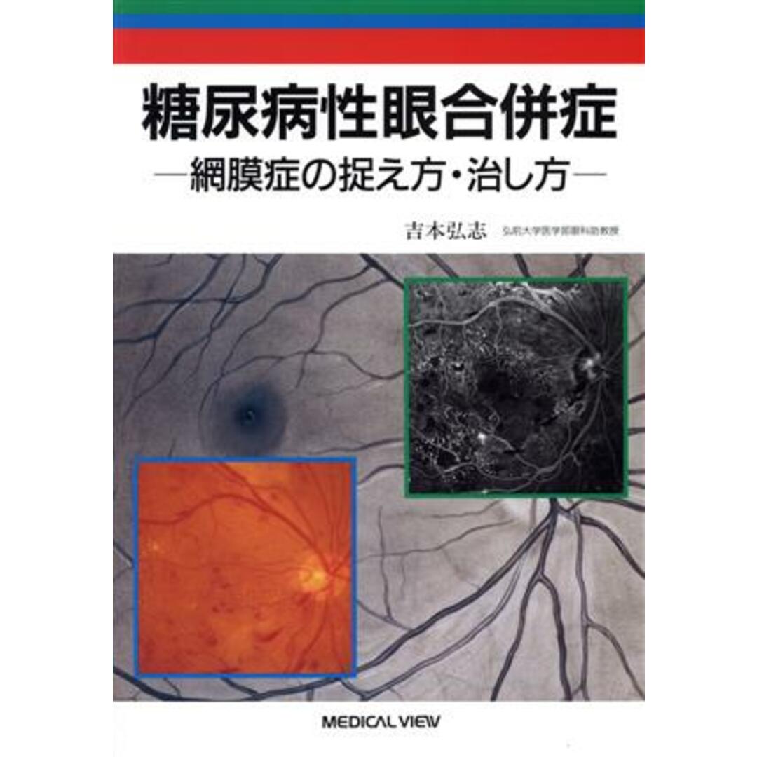 糖尿病性眼合併症 網膜症の捉え方・治し方／吉本弘志(著者) エンタメ/ホビーの本(健康/医学)の商品写真