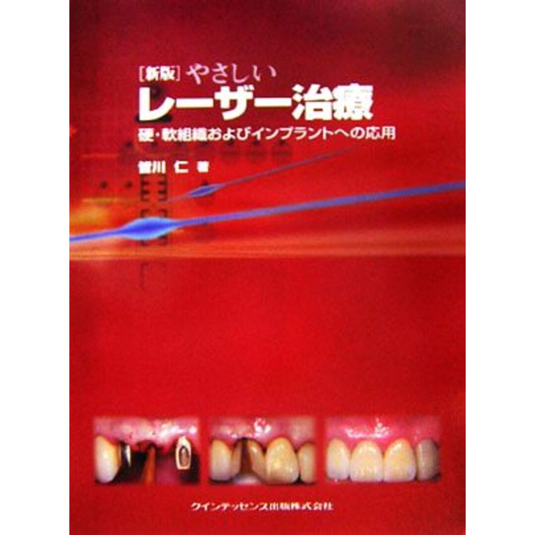 新版　やさしいレーザー治療 硬・軟組織およびインプラントへの応用／皆川仁【著】 エンタメ/ホビーの本(健康/医学)の商品写真