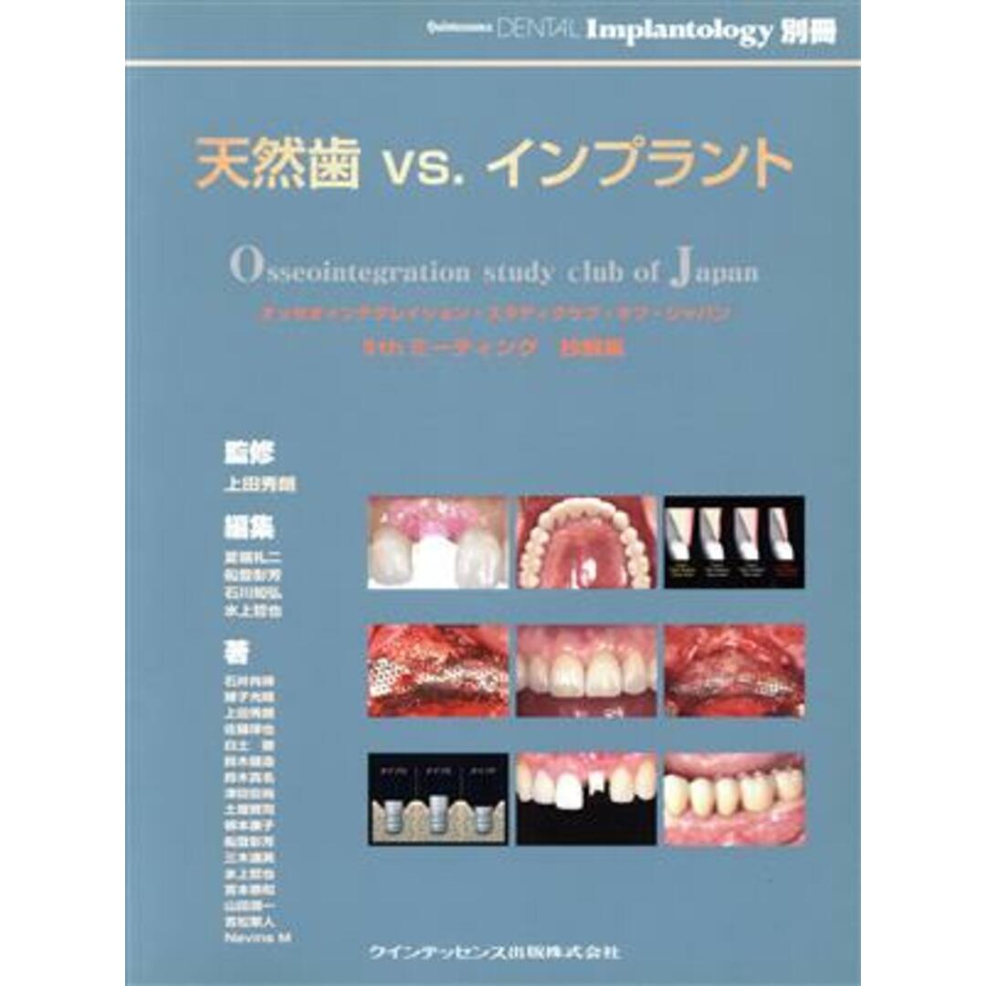 天然歯ｖｓ．インプラント　オッセオインテグレイション・スタデ／夏堀礼二(著者),船登彰芳(著者) エンタメ/ホビーの本(健康/医学)の商品写真