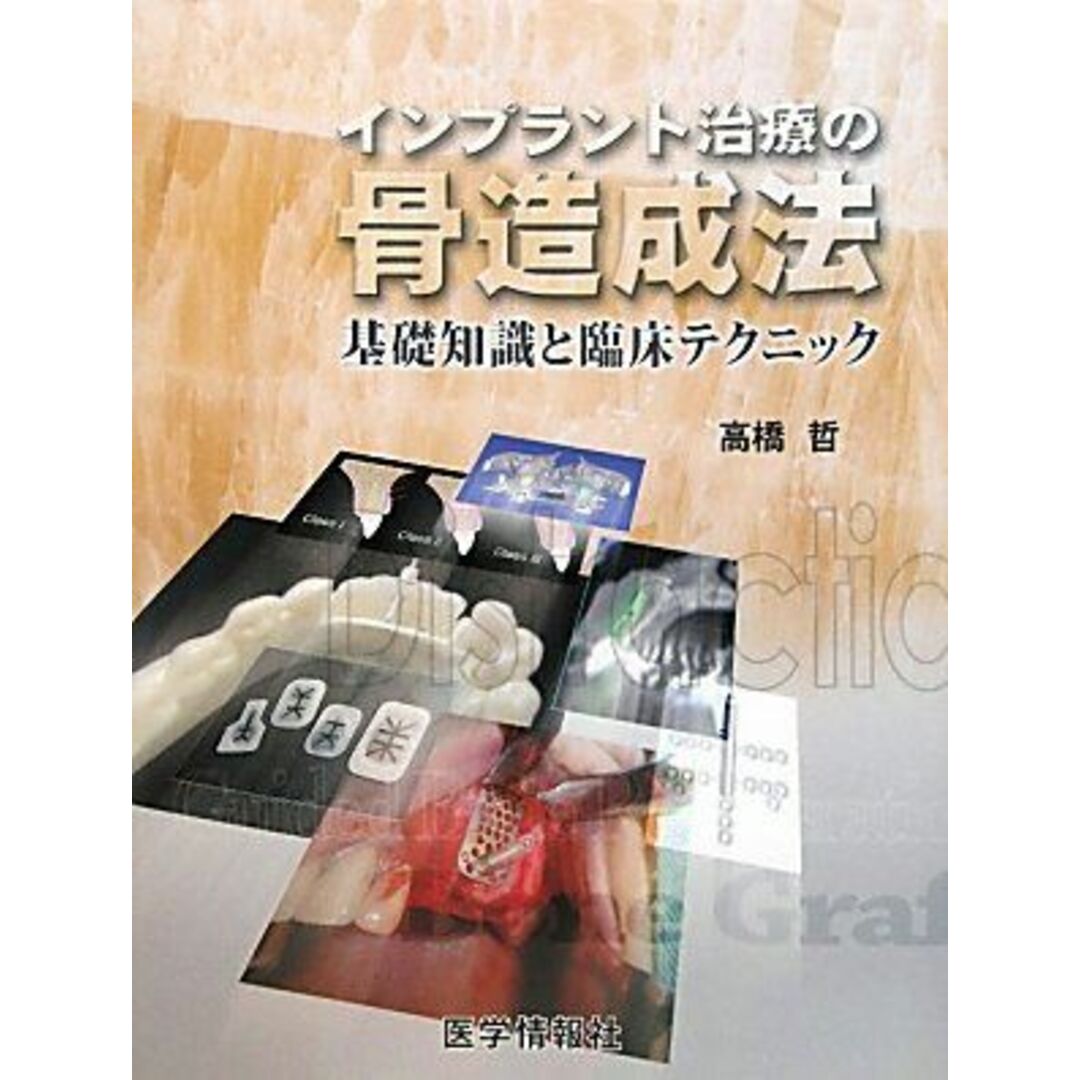 インプラント治療の骨造成法: 基礎知識と臨床テクニック 高橋 哲 エンタメ/ホビーの本(語学/参考書)の商品写真