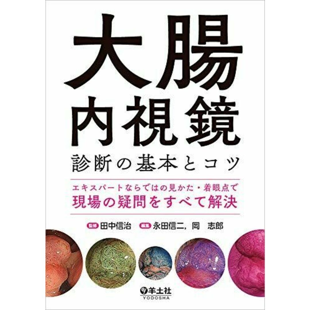 大腸内視鏡診断の基本とコツ?エキスパートならではの見かた・着眼点で現場の疑問をすべて解決