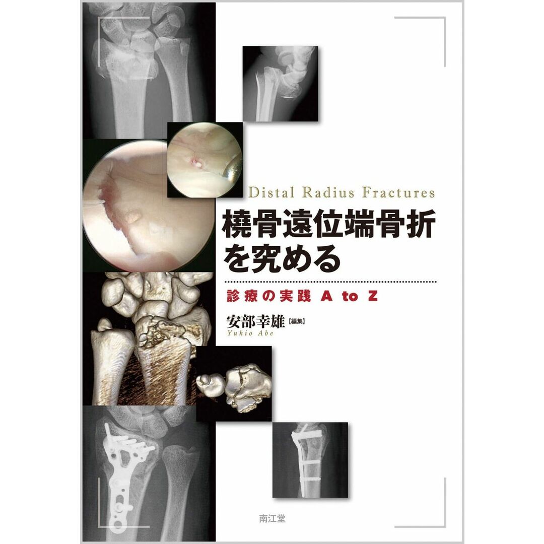 橈骨遠位端骨折を究める: 診療の実践 A to Z エンタメ/ホビーの本(語学/参考書)の商品写真