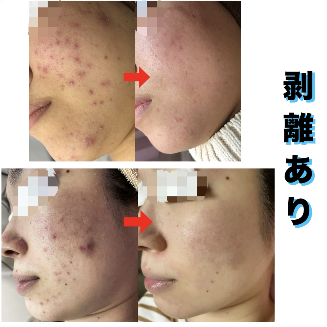 ハーブピーリング 剥離ありの通販 by ぱんだ's shop|ラクマ ハーブピーリング 剥離ありの通販 by ぱんだ's shop|ラクマ