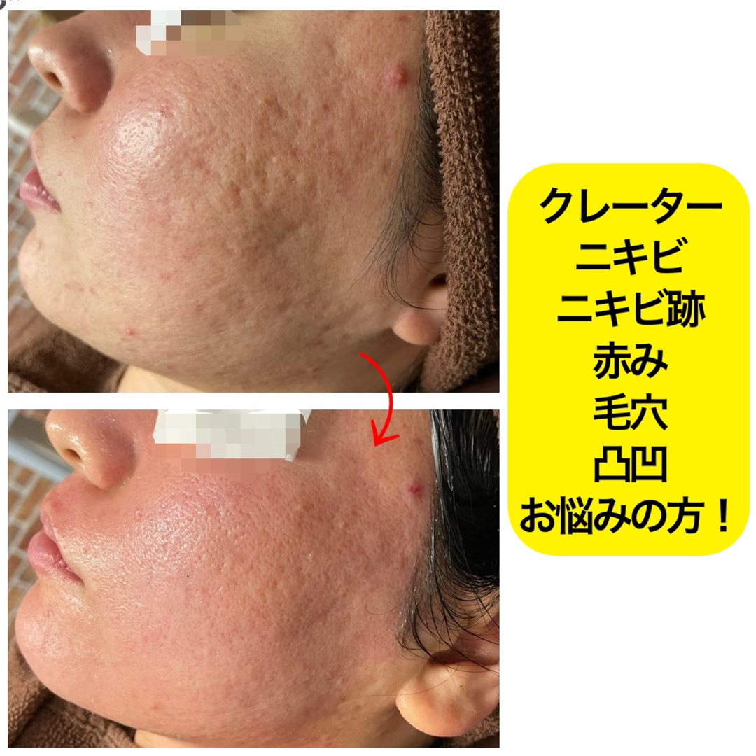 ハーブピーリング 剥離ありの通販 by ぱんだ's shop|ラクマ ハーブピーリング 剥離ありの通販 by ぱんだ's shop|ラクマ
